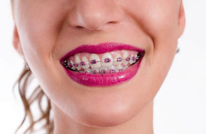 Ortodontik Tedavilerin 5 Önemli Faydası 2 Braketlerle Guzel Fotograf Vermenin Sirlari nedir braket uzmani Dr ozlem aylikci ortodonti uzmani seffaf plak uzmani invisalign uzmani invisalign provider invisalign teen provider