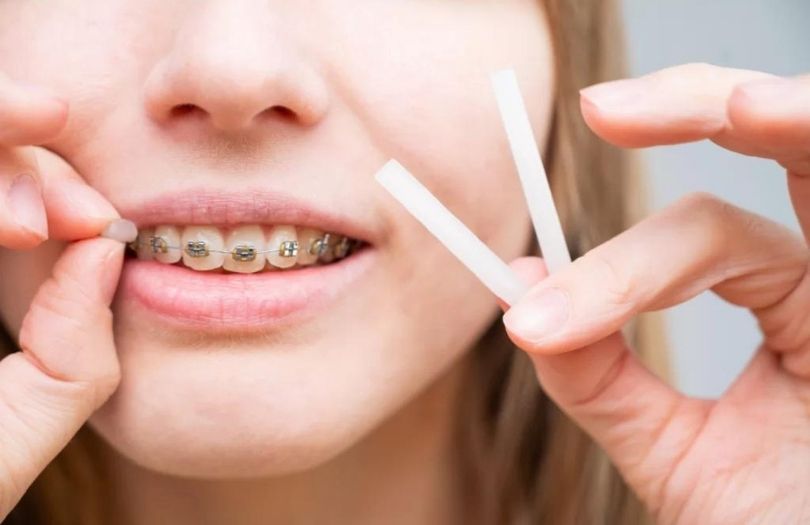 Dis Mumu Dis Teli Agrinizi Azaltacak 10 Ipucu Dr ozlem aylikci ortodonti uzmani seffaf plak uzmani invisalign uzmani invisalign teen provider