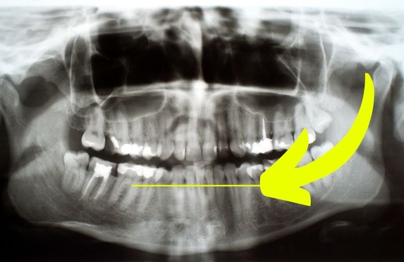 Diş Filminde Nelere Bakıyoruz? 2 Dr ozlem aylikci ortodonti uzmani seffaf plak uzmani invisalign uzmani alveoler kemik seviyesi
