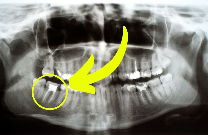Diş Filminde Nelere Bakıyoruz? 5 Dr ozlem aylikci ortodonti uzmani seffaf plak uzmani invisalign uzmani hatali kanal dolgusu