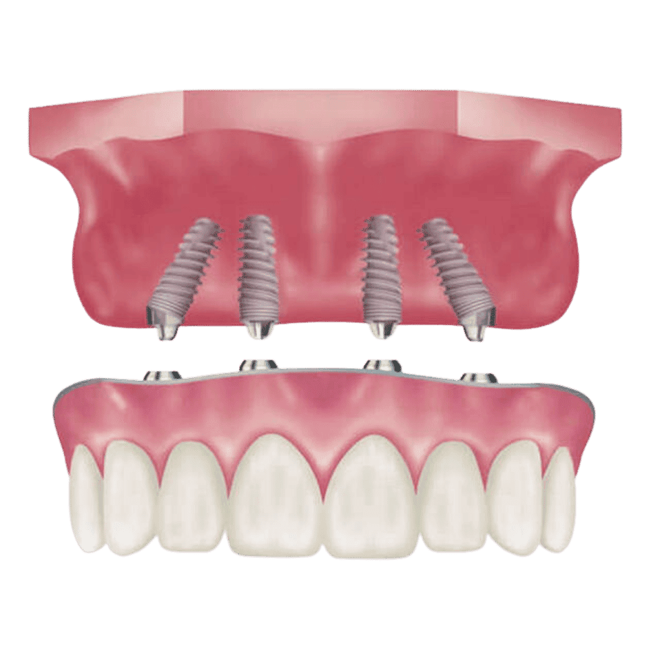 Dental İmplant 6 Uzman dr. Bahadir ugur aylikci all on four implant all on 4 implant
