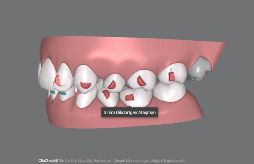 invisalign atacman Uzman dr. ozlem aylikci Drozlemorto