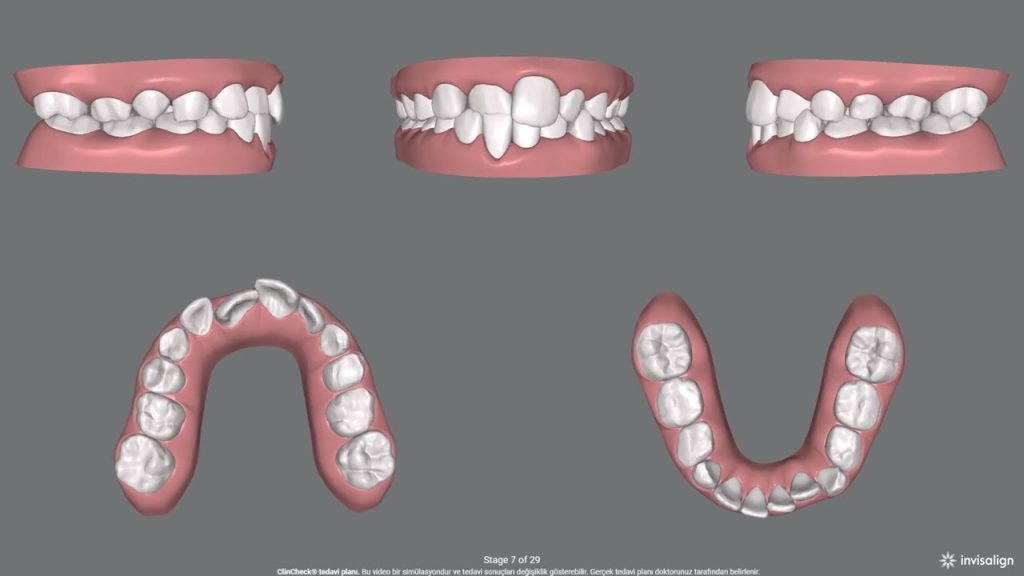 Invisalign First nedir? 5 2 invisalign first cocuklarda in