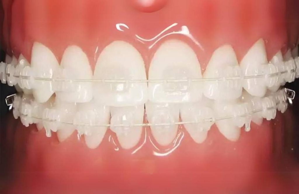 Estetik Braketler 5 3m clarity advance dr ozlem aylikci ortodonti uzmani seffaf braketler dis yuzeinde braket gorunmesin typodont
