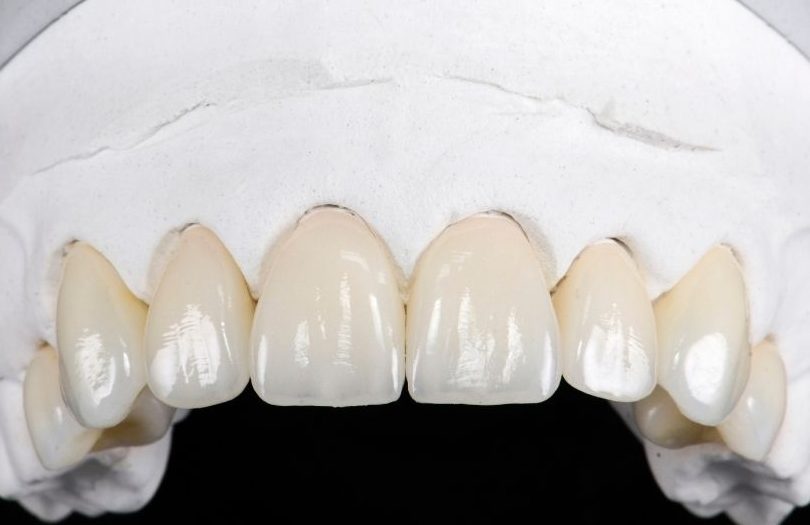 Zirkonyum Kaplamalar 10 Dr. Ozlem Aylikci Drozlemorto Gulus Tasarim Uzmani dr. Bahadir Ugur Aylikci E Max veneer Emax kaplama model farkli vaka rotated