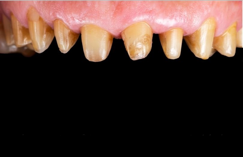 Zirkonyum Kaplamalar 8 Dr. Ozlem Aylikci Drozlemorto Gulus Tasarim Uzmani dr. Bahadir Ugur Aylikci Zirkonyum Veneer Zirkonyum Kaplama before 3