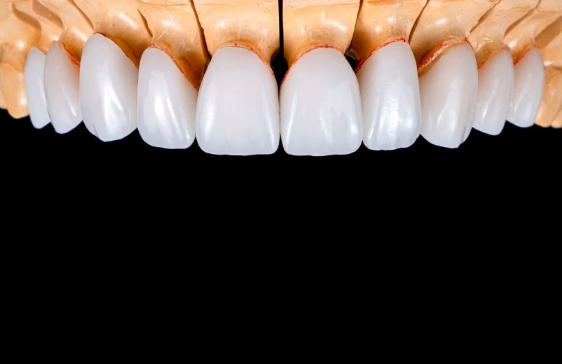 Zirkonyum Kaplamalar 7 Dr. Ozlem Aylikci Drozlemorto Gulus Tasarim Uzmani dr. Bahadir Ugur Aylikci Zirkonyum Veneer Zirkonyum Kaplama case model