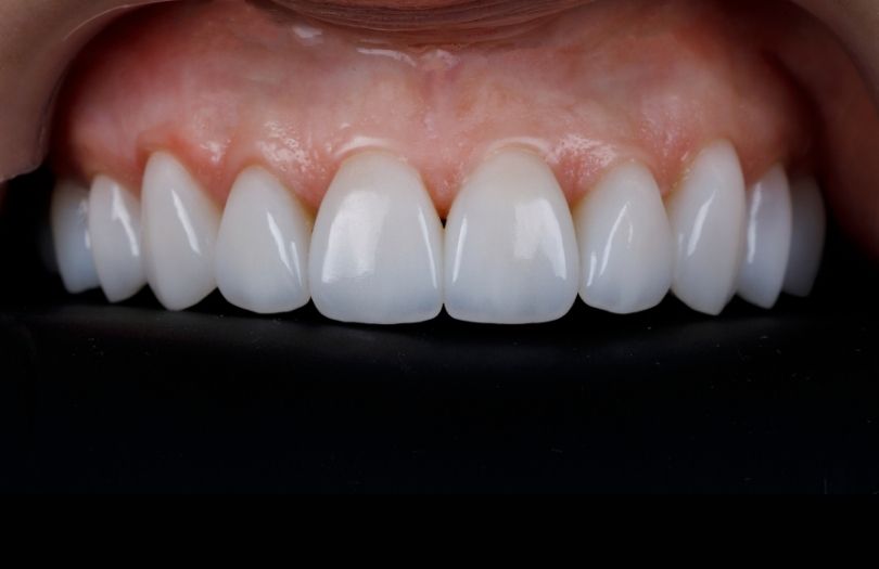 Zirkonyum Kaplamalar 9 Dr. ozlem aylikci Drozlemorto Gulus tasarim uzmani dr. Bahadir Ugur Aylikci zirkonyum veneer zirkon kaplama 3