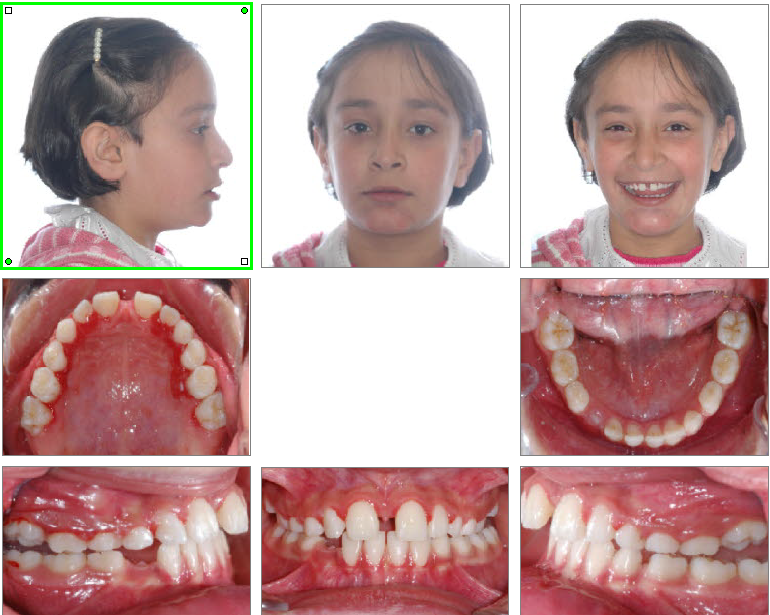 Ortodonti Uzmani Dr. Ozlem Aylikci 10 after