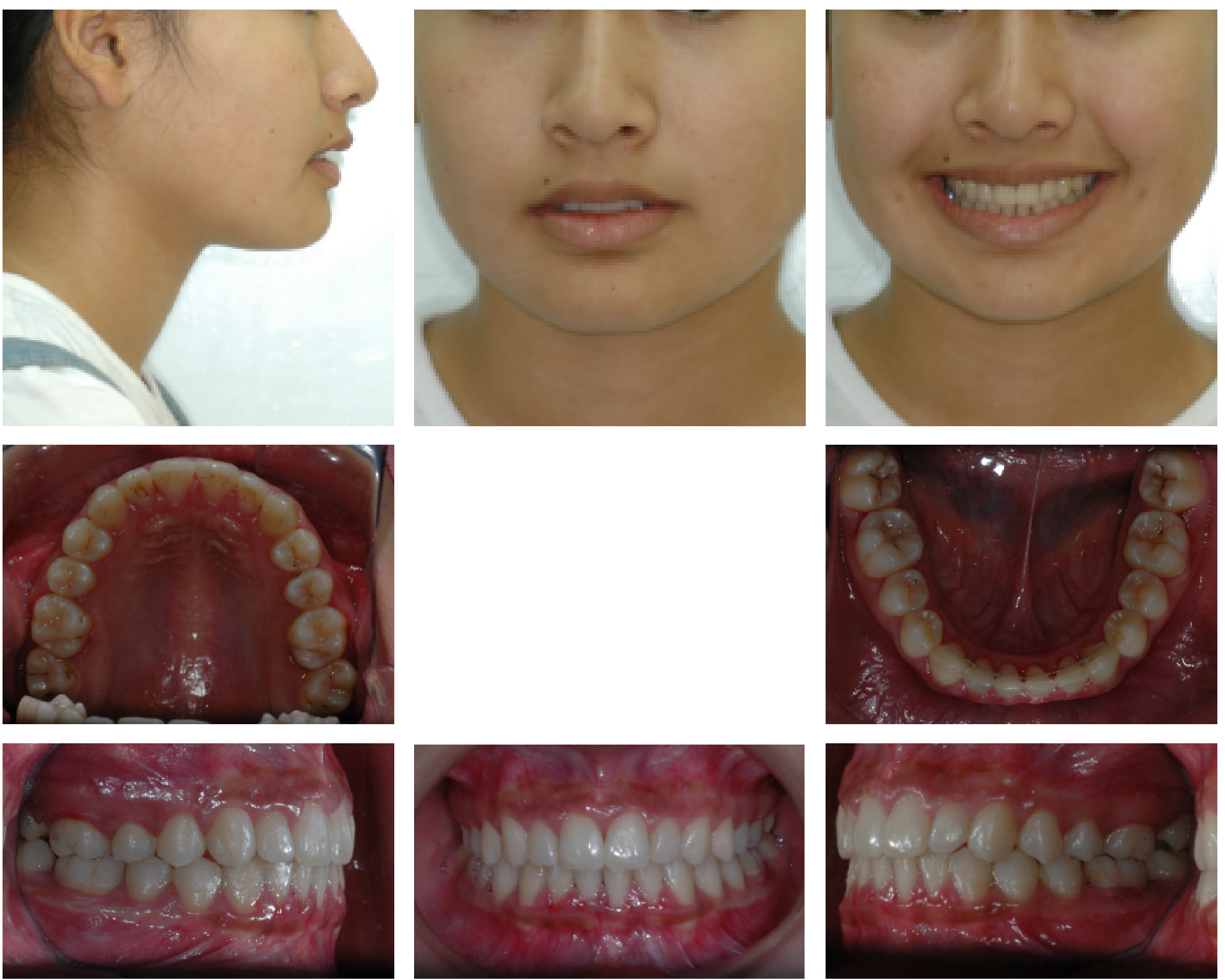 Ortodonti Uzmani Dr. Ozlem Aylikci 11 after
