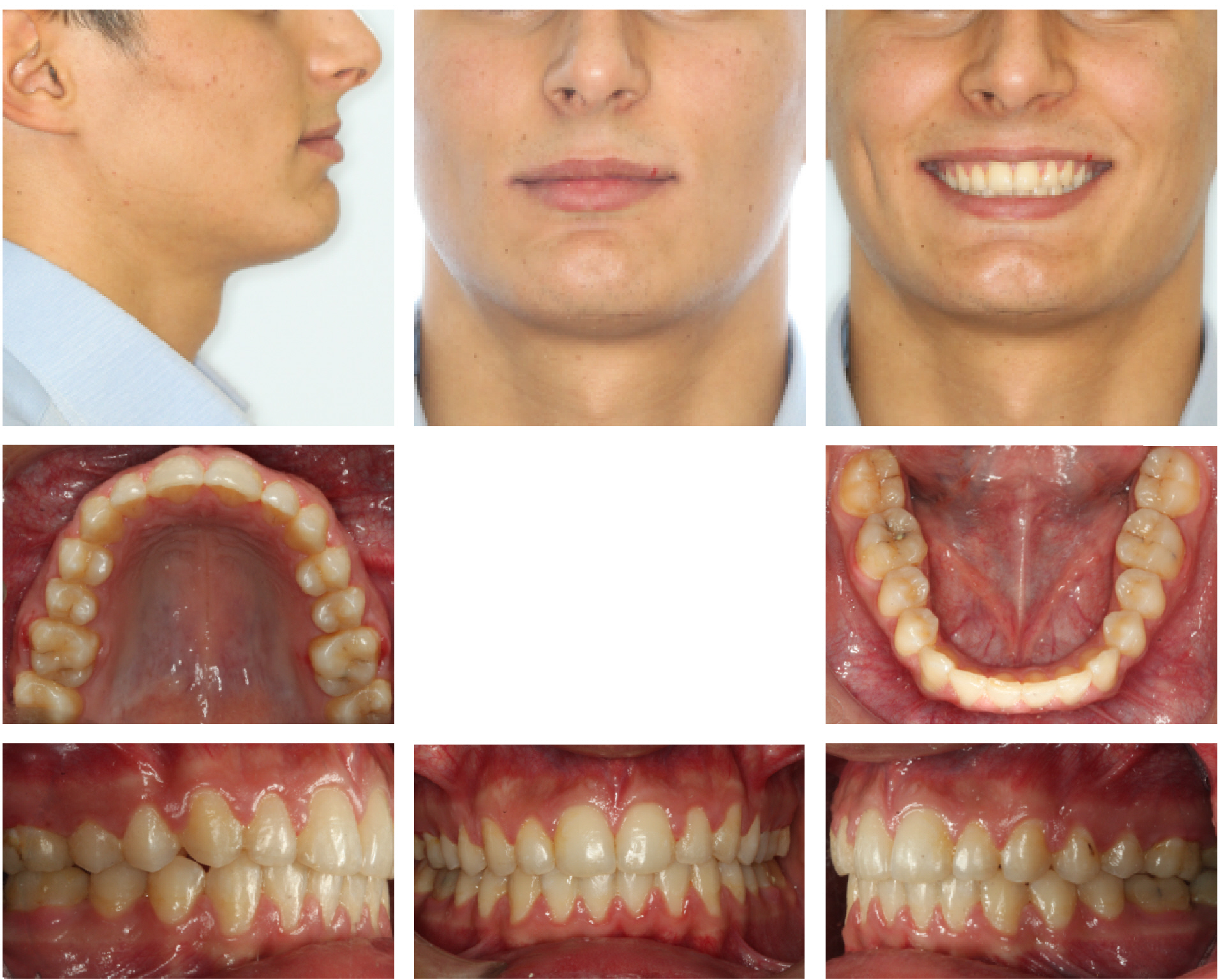 Ortodonti Uzmani Dr. Ozlem Aylikci 2 after