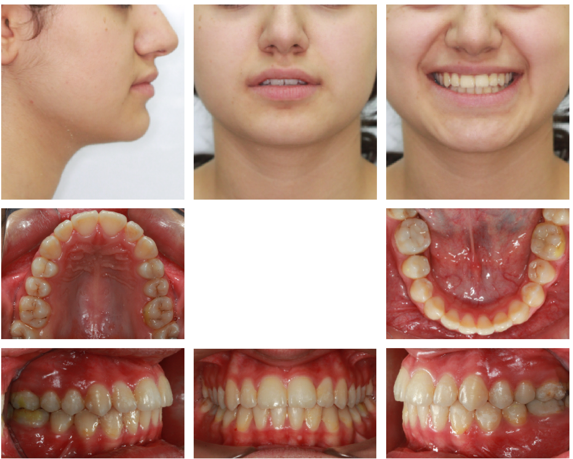 Ortodonti Uzmani Dr. Ozlem Aylikci 7 after