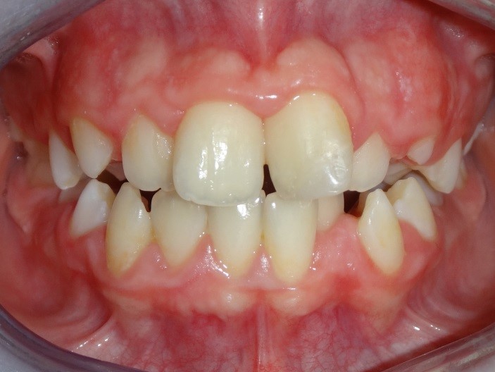 Çocuk Ortodontisi 1 ortodonti uzmanı dr. özlem aylıkcı Çocuk ortodontisi Çocuklarda ortodonti invisalign teen invisalign first çocuklarda şeffaf plak