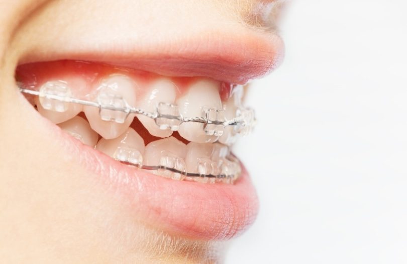 Estetik Braketler 3 dr ozlem aylikci ortodonti uzmani diger estetik braketler e1703059960531