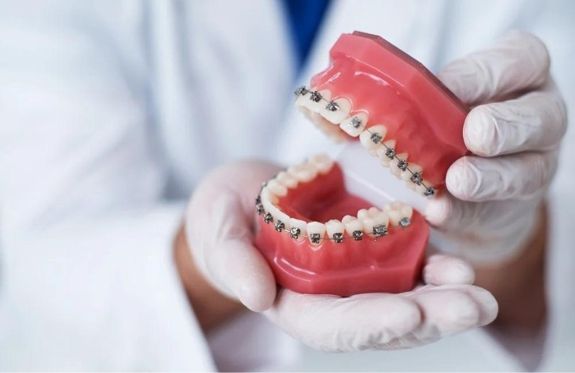 Ortodonti uzmanı özlem aylıkcı metal diş telleri metal braket klasik ortodonti en iyi ortodonti uzmanı