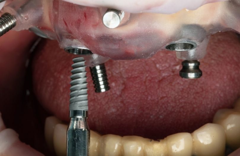 Dental İmplant 2 Dr. Ozlem Aylikci Drozlemorto Gulus Tasarim Uzmani dr. Bahadir Ugur Aylikci Dental Implant yerlestirme rehber 2