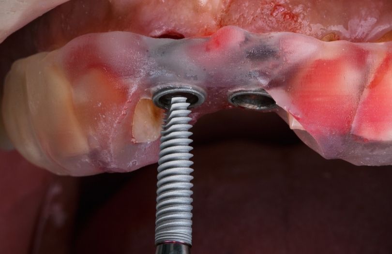 Dental İmplant 3 Dr. Ozlem Aylikci Drozlemorto Gulus Tasarim Uzmani dr. Bahadir Ugur Aylikci Dental Implant yerliestirme rehber