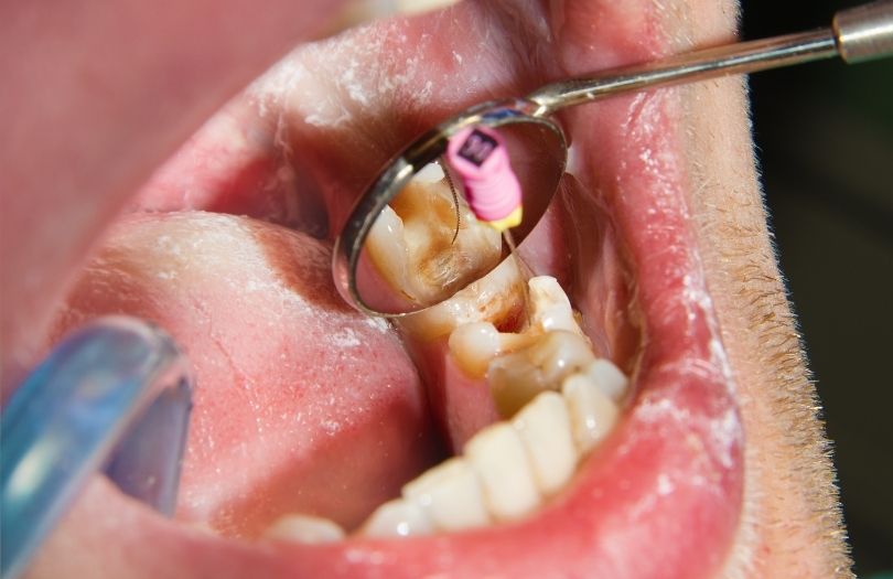 Kanal Tedavisi – Endodonti 3 Dr. Ozlem Aylikci Drozlemorto Gulus Tasarim Uzmani dr. Bahadir Ugur Aylikci Endodontic Treatment Kanal Tedavisi 2