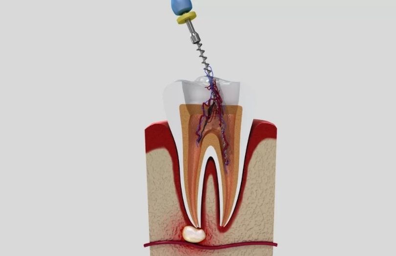 Kanal Tedavisi – Endodonti 1 Dr. Ozlem Aylikci Drozlemorto Gulus Tasarim Uzmani dr. Bahadir Ugur Aylikci Endodontic Treatment