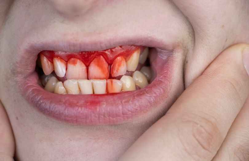 Gingivitis – Diş Eti İltihabı dr bahadır uğur aylıkcı diş eti uzmanı. uzman dr. özlem aylıkcı ortodonti uzmanı