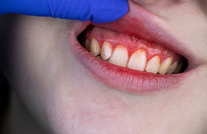 Gingivitis – Diş Eti İltihabı dr bahadır uğur aylıkcı diş eti uzmanı