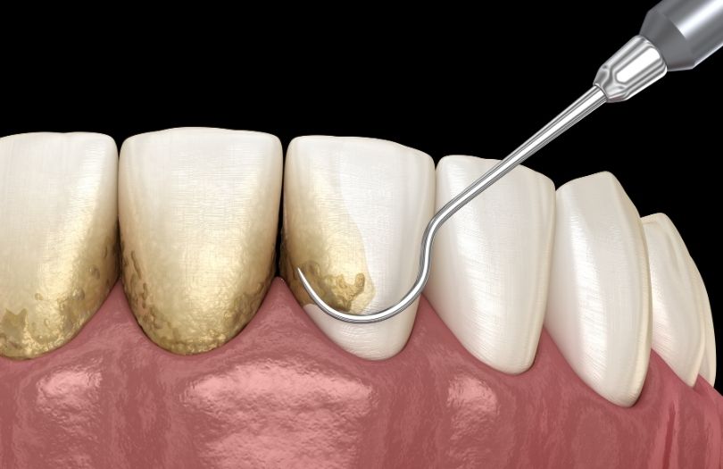 Dr. Ozlem Aylikci Drozlemorto Gulus Tasarim Uzmani dr. Bahadir Ugur Aylikci Gingivitis scaling gorseli