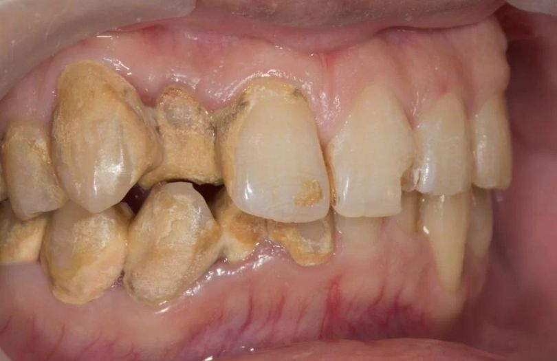 Gingivitis – Diş Eti İltihabı dr bahadır uğur aylıkcı diş eti uzmanı