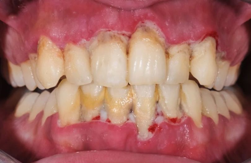 Dr. Ozlem Aylikci Drozlemorto Gulus Tasarim Uzmani dr. Bahadir Ugur Aylikci Periodontitis doku kaybi