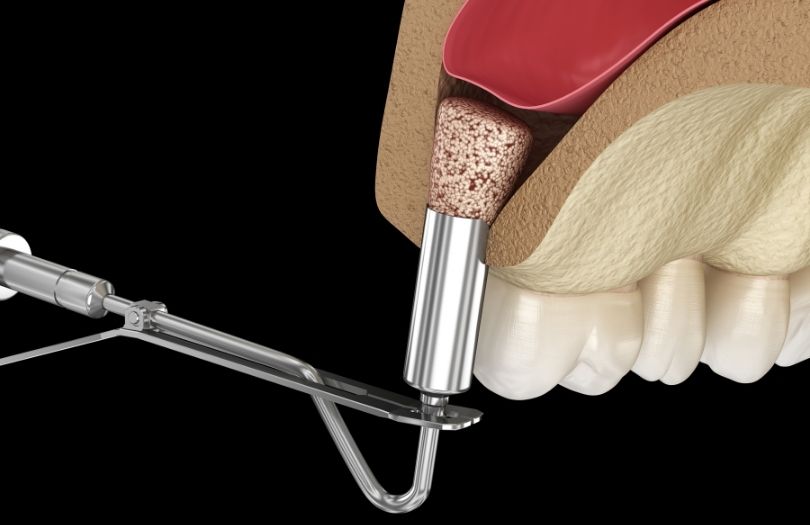 Sinüs Lifting 4 Dr. Ozlem Aylikci Drozlemorto Gulus Tasarim Uzmani dr. Bahadir Ugur Aylikci implanta Hazirlik sinus lift greftleme