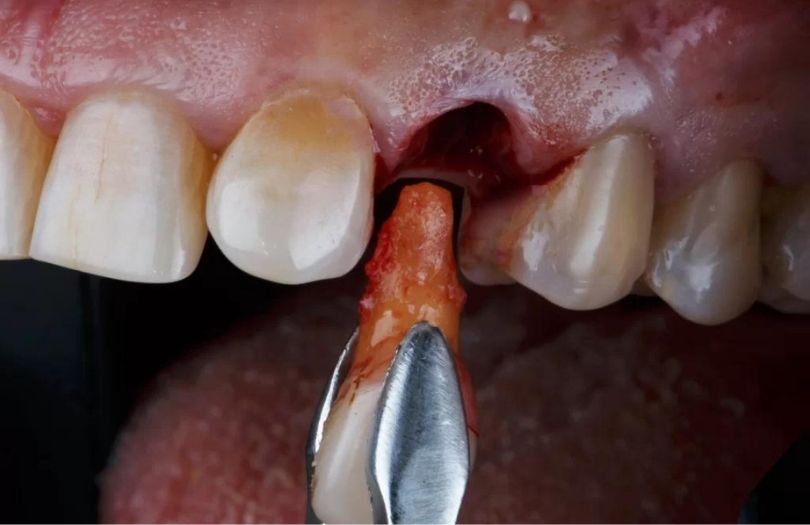Fırlak Dişler 7 dis cekimi Dr Bahadir Ugur Aylikci lamine Uzmani Implant Uzmani Dis eti Uzmani Periodontoloji Uzmani Gulus Tasarimi Uzmani
