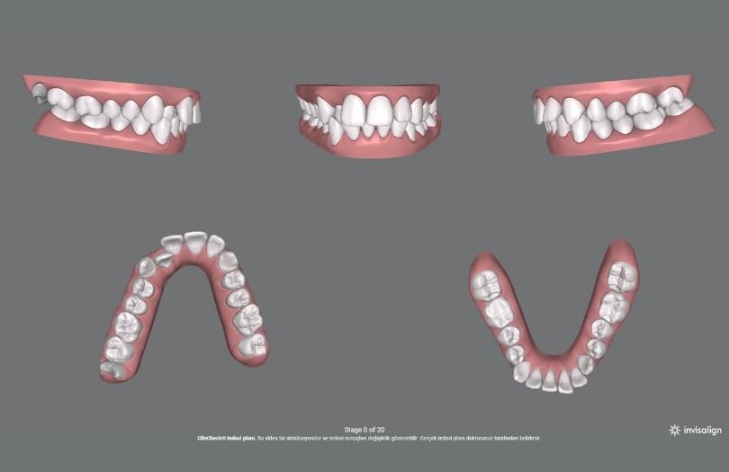 20 plak Drozlemorto Dr Ozlem Aylikci dis teli seffaf plak invisalign orthero lingual tel sakli tel invisalign teen implant gulus tasarimi diseti uzmani