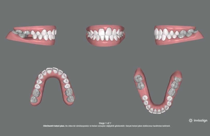 7 plak express Drozlemorto Dr Ozlem Aylikci dis teli seffaf plak invisalign orthero lingual tel sakli tel invisalign teen implant gulus tasarimi diseti uzmani