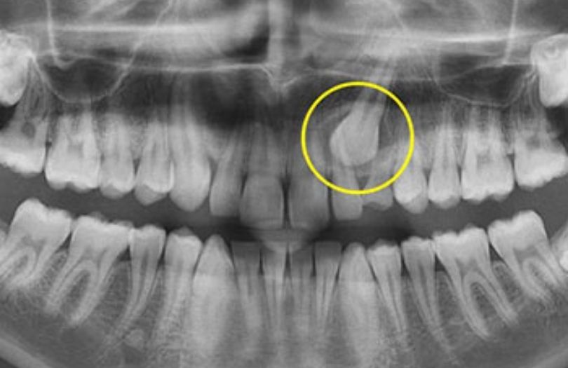 Çocuk Ortodontisi 3 ortodonti uzmani dr. ozlem aylikci gomulu kanin disi seffaf plak uzmani invisalign first
