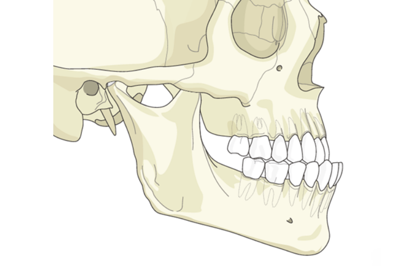 Alt Çenenin Önde Olması 4 idkeletsel alt cene ondeligi alt cene onde oldugu durumlarda tedaviler nelerdir drozlemorto