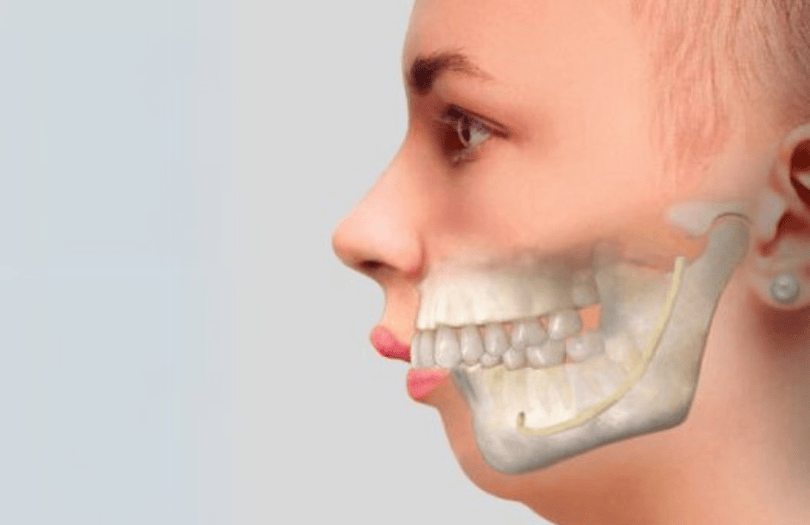 Invisalign First nedir? 9 Firlak disler drozlemorto ust cene buyuk alt cee kucuk sisli ortodonti klinigi
